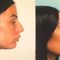 Understanding Rhinoplasty: A Comprehensive Guide to Enhancing Your Appearance