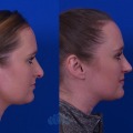 Open vs. Closed Rhinoplasty: Understanding Your Options