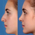 What is difference between plastic and cosmetic surgery?