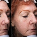 The Benefits of Fractional Laser Therapy for Cosmetic Enhancement