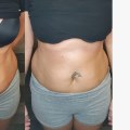 A Comprehensive Look at Ultrasonic Liposuction for Body Contouring