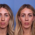 All About Facelift: Enhancing Your Appearance with Cosmetic Surgery