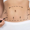 All About Mini Tummy Tuck: Enhance Your Appearance with This Body Contouring Procedure