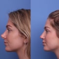 Revision Rhinoplasty: Everything You Need to Know