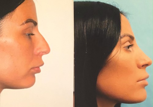 Understanding Rhinoplasty: A Comprehensive Guide to Enhancing Your Appearance