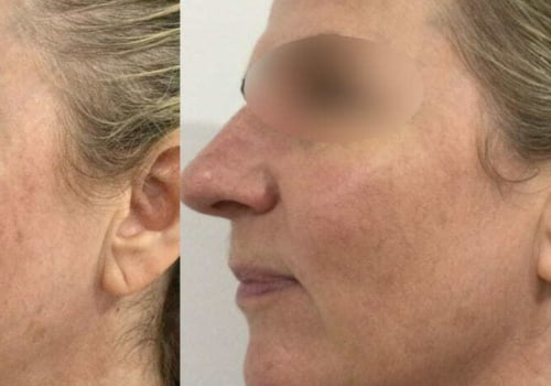 Understanding Ultherapy: A Non-Surgical Alternative for Skin Tightening