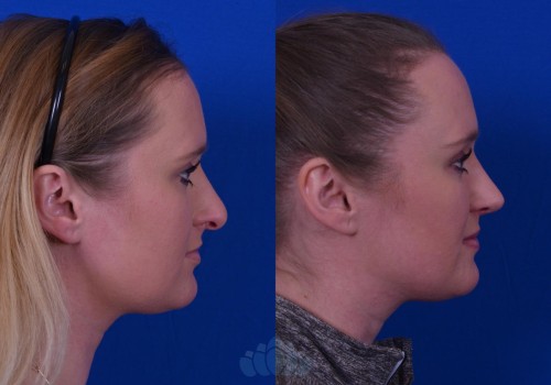 Open vs. Closed Rhinoplasty: Understanding Your Options