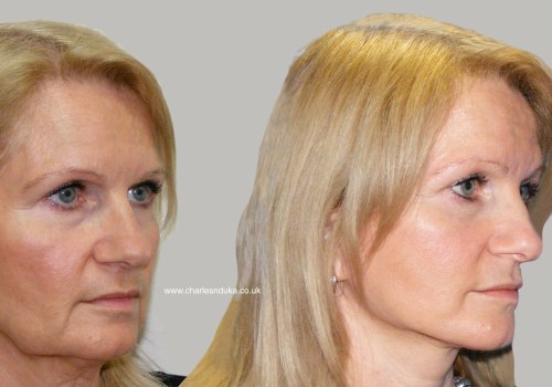 Understanding Traditional Facelift: Enhancing Your Appearance Through Cosmetic Surgery