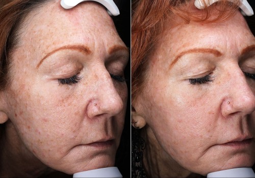 The Benefits of Fractional Laser Therapy for Cosmetic Enhancement