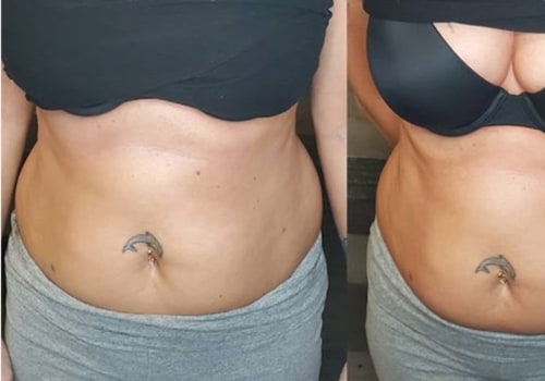 A Comprehensive Look at Ultrasonic Liposuction for Body Contouring