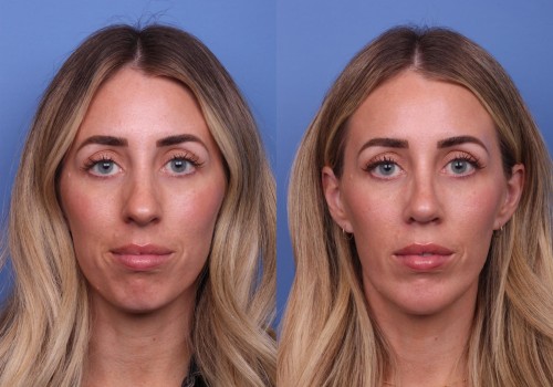 All About Facelift: Enhancing Your Appearance with Cosmetic Surgery