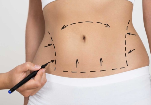 All About Mini Tummy Tuck: Enhance Your Appearance with This Body Contouring Procedure