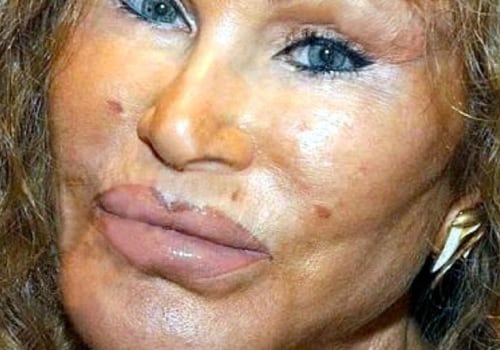 What is the most extreme cosmetic surgery?