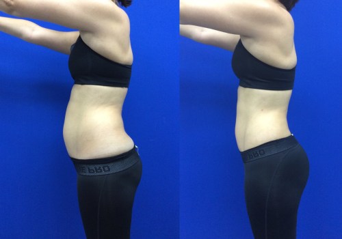 Understanding Laser-Assisted Liposuction: What You Need to Know