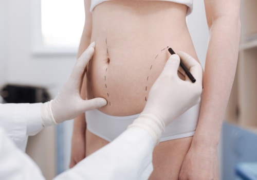 All You Need to Know About Traditional Liposuction