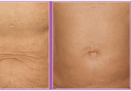 Understanding Radiofrequency Skin Tightening