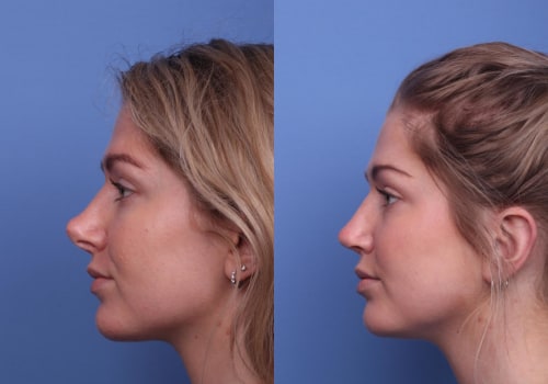 Revision Rhinoplasty: Everything You Need to Know